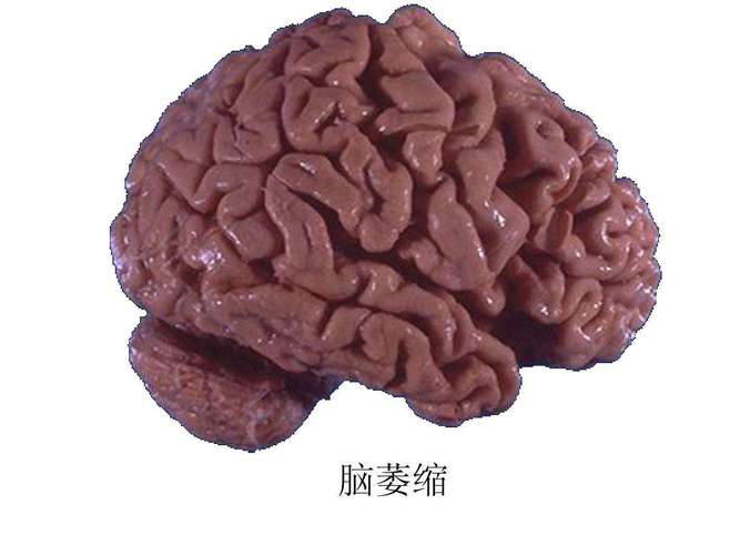 2025澳门天天开好彩免费和送小脑萎缩儿子高考与小脑萎缩能上学吗